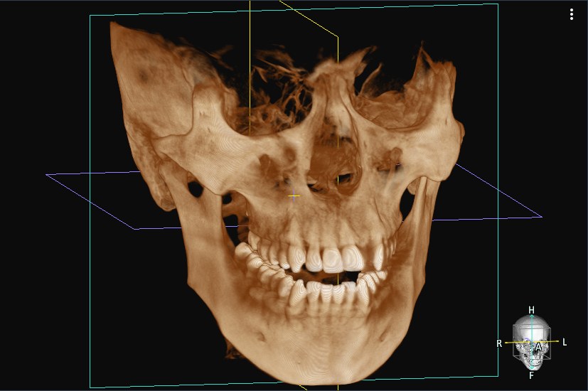 3D CT로 재구성한 위아래 턱과 치아의 입체 영상