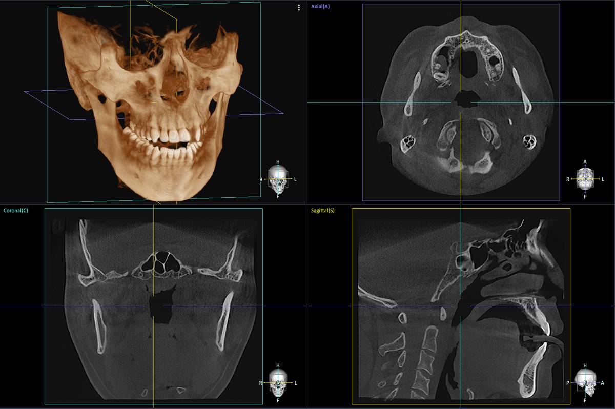 3D CT의 다면 재구성 화면 — 3D 입체 영상과 세 방향 단면