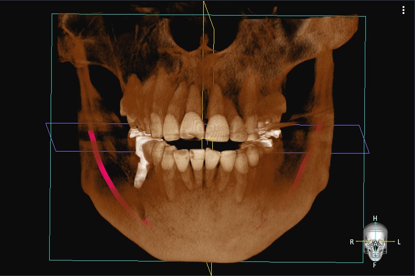 3D CT 영상에서 붉은 선으로 표시된 하치조신경관